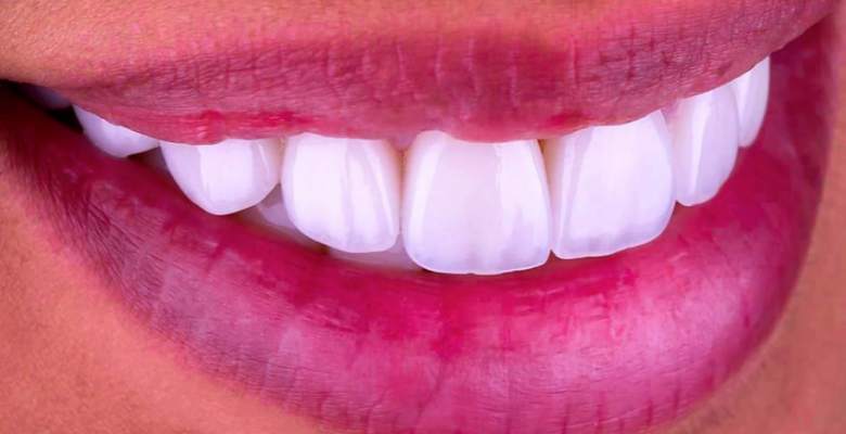 porcelain-veneers