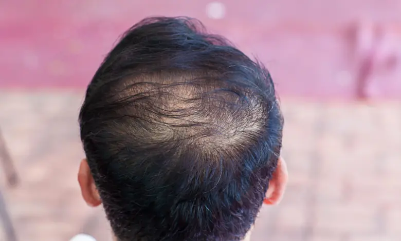 Hair Loss